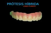 Protesis hibrida ,sobre implantes dentales