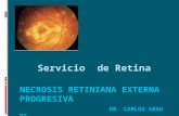 Necrosis retiniana externa progresiva porn