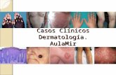 Casos Clínicos Dermatología. AulaMir. Caso 6 Paciente de 37 años que consulta por pérdida progresiva de agudeza visual, lesiones palmo- plantares y alopecia.