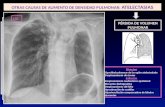 OTRAS CAUSAS DE AUMENTO DE DENSIDAD PULMONAR: ATELECTASIAS PÉRDIDA DE VOLUMEN PULMONAR Directos Opacidad pulmonar de la región atelectasiada Desplazamiento.