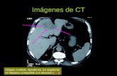 Imágenes de CT Imagen ovalada, hipodensa, en segmento IV hepático compatible con absceso ( )