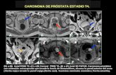 CARCINOMA DE PRÓSTATA ESTADIO T4. ( A) y (B) Axial FRSE T2. (C) y (D) Coronal FRSE T2, (E) y (F) Axial 3D FSPGR. Carcinoma prostático con extensión extracapsular.
