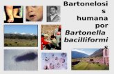 Bartonelosis humana por Bartonella bacilliformis.