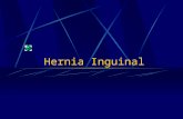 Hernia Inguinal. Números Incidencia 15:1000. 700,000 herniplastías inguinales se realizan por año en U.S.A.