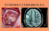 Clase 3 Tumores Cerebra Les