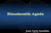 Sinusistis aguda -  Juan CarLo  Santillan Nuñez