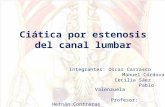 Ciatica por estenosis del canal lumbar(1