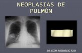 Neoplasias de pulmón