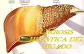 Cirrosis HepÁtica Acabada Entregar Xp