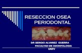 Reseccion Osea Periodontal