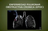 Enfermedad pulmonar obstructiva cronica (epoc)