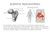 Bursitis trocantereana