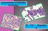 Leucemia linfoide crã³nica