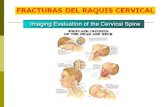 Cervical fracture