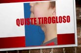 Quiste tirogloso (2)