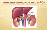 Tumores benignos del riñón