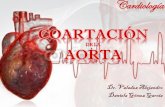 Coartacion aortica