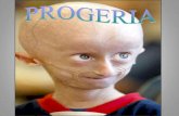 Progeria ppt 2013