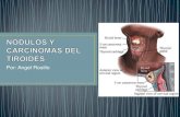 Nódulos y carcinomas de tiroides