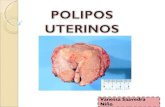 Polipos endometriales y endocervicales