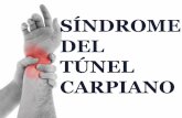 Síndrome del Túnel Carpiano