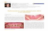 Definiendo caries dental