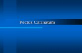 Pectus Carinatum