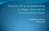 Fistulas De Anastomosis Esofagoyeyunal