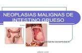 Neoplasias malignas de intestino grueso