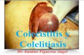 Colecistitis y coledocolitiasis enarm