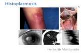 Histoplasmosis diseminada de la infancia