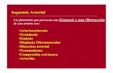 Isquemia arterial aguda