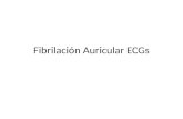 Fibrilación auricular ECGs