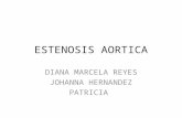 Presentacion Estenosis Aortica