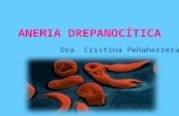 Anemia Drepanocítica