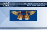 Fractura alveolar y avulsion dentaria,