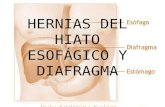 Hernias del hiato esofágico y diafragma