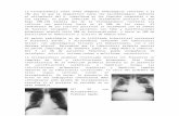 DX Diferencial Histoplasmosis TBC
