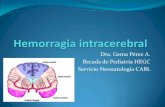 Hemorragia intraventricular