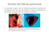 Torsión del lobulo Pulmonar