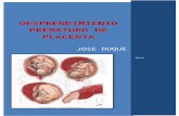 Desprendimiento Prematuro de La Placenta Normoinserta Duque