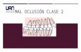 Mal Oclusion Clase II