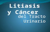Litiasis y Cáncer Tracto Urinario