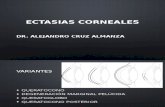 Ectasias corneales
