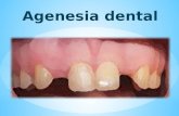 agenesia dentaria