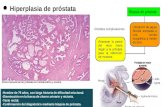 Patología - Hiperplasia de Próstata