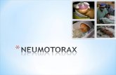 * El neumotórax es una acumulación de aire extrapulmonar dentro del tórax. * 1-2% de todos los RN presenta neumotórax asintomáticos, normalmente unilaterales.