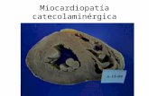 Miocardiopatía catecolaminérgica. Historia clínica Varón de 29 años de edad, sin antecedentes de interés que, estando en reposo, sufre un cuadro sincopal.