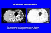 Paciente con dolor abdominal Cortes axiales con imagen de gas de dudosa localización, que comprime cámara gástrica.