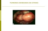 TUMORES BENIGNOS DE ÚTERO. MIOMATOSIS UTERINA  Los miomas son tumores benignos formados de fibras musculares lisas (miometrio) y que contienen además.